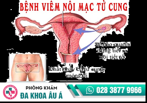 Viêm nội mạc tử cung dẫn đến tình trạng quan hệ ra máu